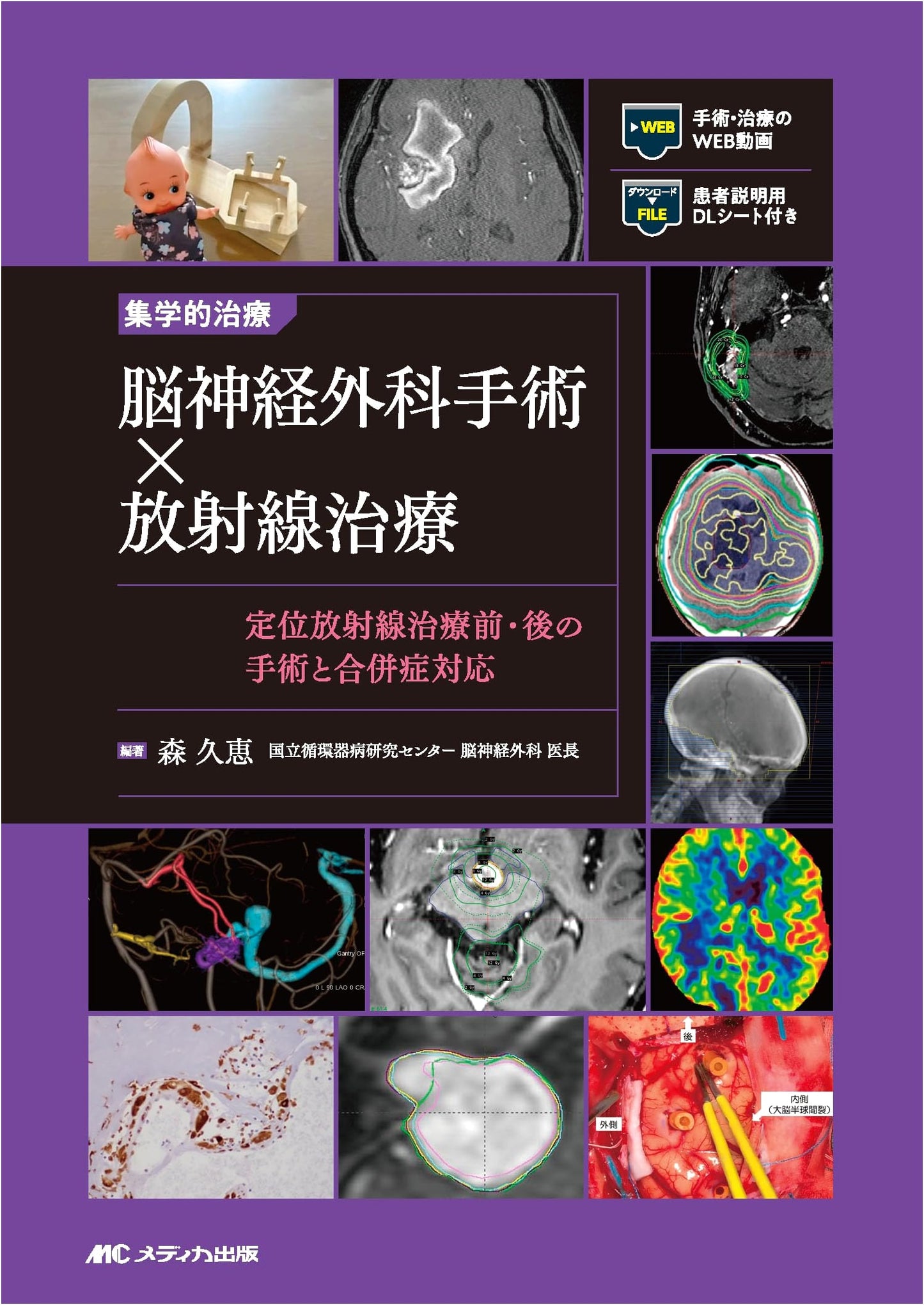 Multidisciplinary Treatment in Neurosurgery: Surgery & Radiotherapy for Brain Tumors