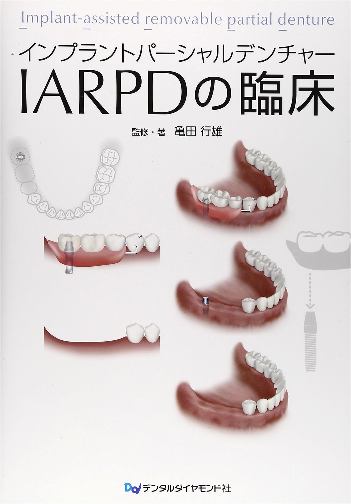 Clinical Applications of Implant-Supported Removable Partial Dentures (IARPD)