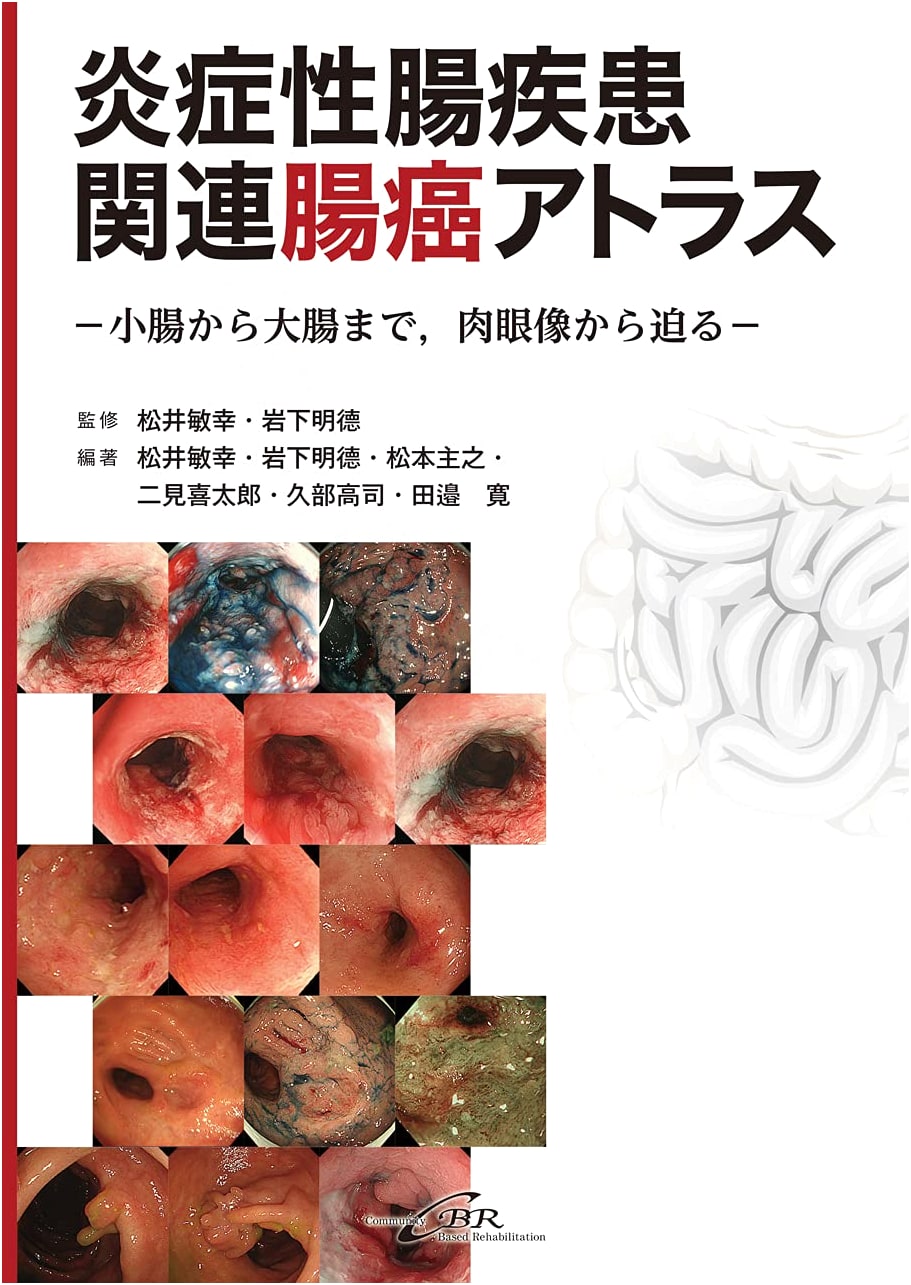 Inflammatory Bowel Disease-Related Bowel Cancer Atlas: Small to Large Intestine